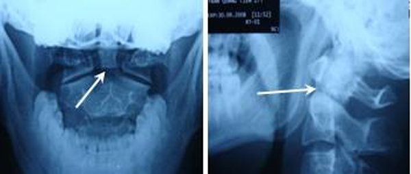 Gãy mỏm nha loại 2