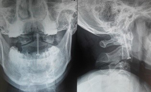 Phim chụp cắt lớp vi tính sau mổ vít trực tiếp mỏm nha
