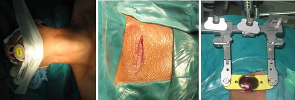 Tư thế, rạch da, đặt hệ thống vén