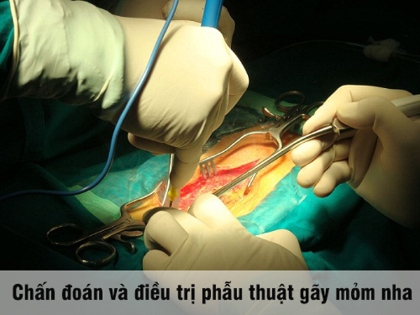 Chấn đoán và điều trị phẫu thuật gãy mỏm nha Tại Bệnh Viện Bạch Mai