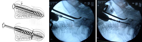 Đặt vít trực tiếp mỏm nha