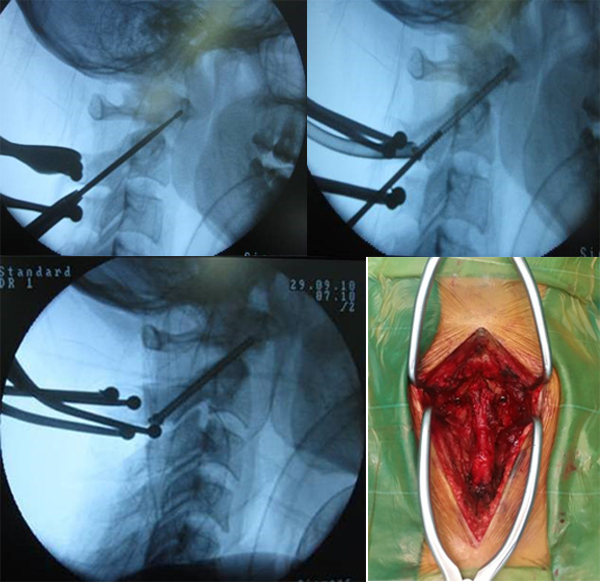 Hình 2.17. Mô tả kỹ thuật vít qua khớp C1 - C2 trên màn tăng sáng