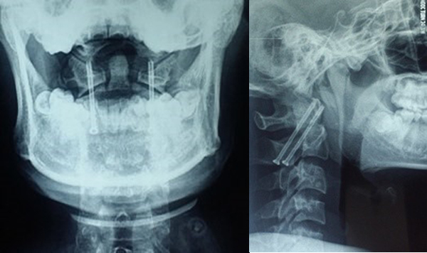 X quang quy ước sau mổ vít qua khớp