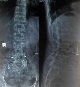 Phim X-quang khối u phá hủy thân đốt L5