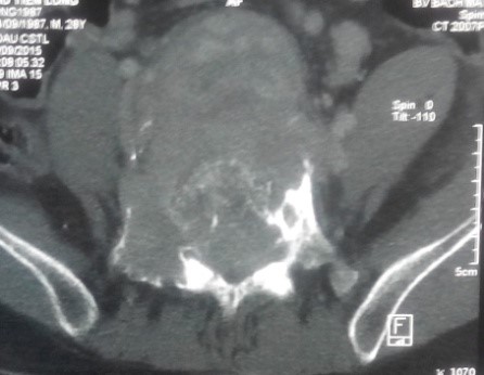 CT scanner: khối u phá hủy thân đốt L5
