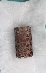 lồng titan thay thế