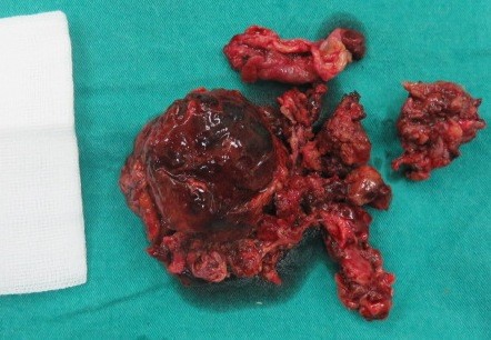 Khối u sau khi cắt ra