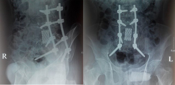 Phim chụp sau mổ