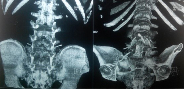 Phim chụp sau mổ