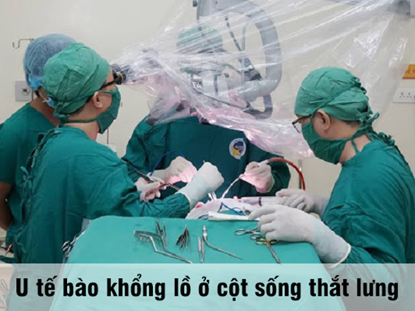 U tế bào khổng lồ ở cột sống thắt lưng
