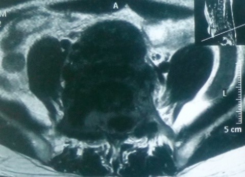 U xâm lấn trên phim MRI