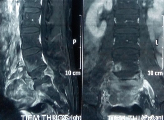 Phim MRI có tiêm thuốc