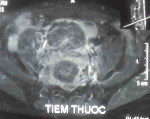 Phim MRI có tiêm thuốc