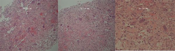 Tiêu bản sinh thiết