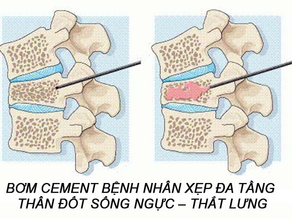 ĐÁNH GIÁ KẾT QUẢ PHẪU THUẬT BƠM CEMENT BỆNH NHÂN XẸP ĐA TẦNG THÂN ĐỐT SỐNG NGỰC – THẮT LƯNG DO LOÃNG XƯƠNG