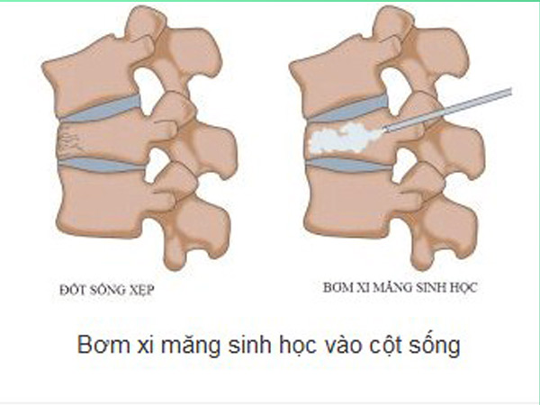 Bơm Cement vào cột sống