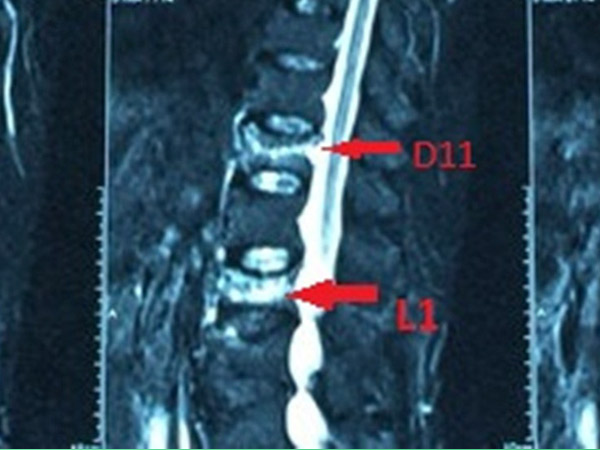 Hình ảnh xquang xẹp đốt sống