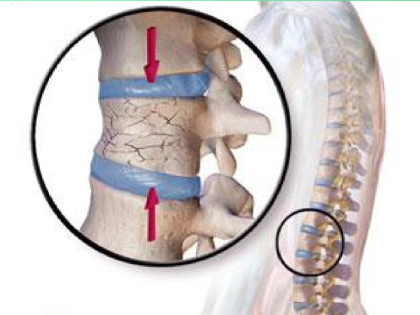 Xẹp đốt sống thắt lưng