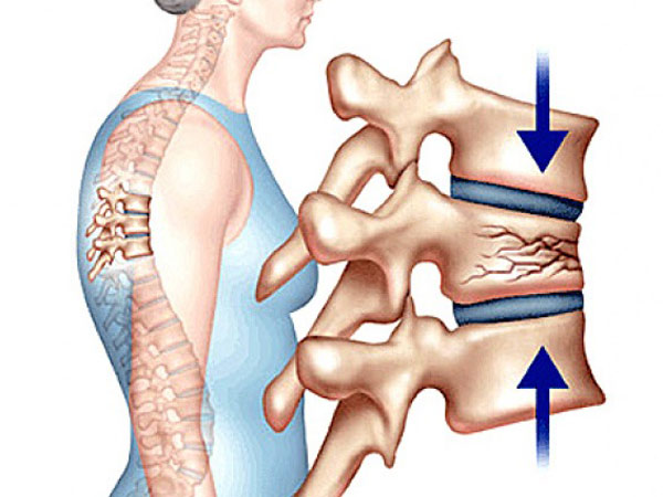 Hình ảnh xẹp đốt sống ngực