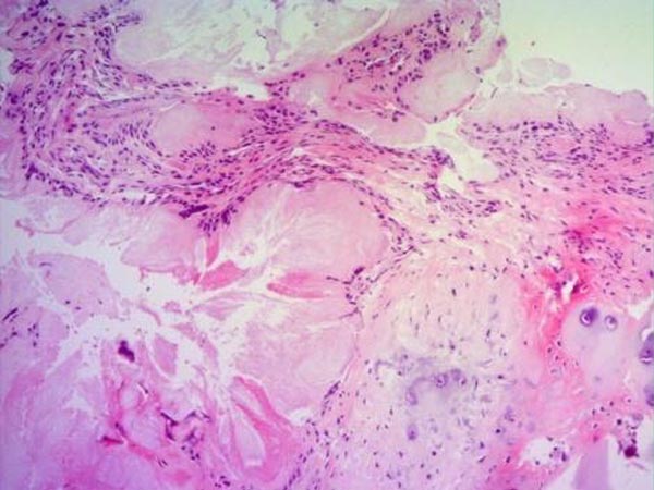 Hình 4: Hình ảnh giải phẫu bệnh