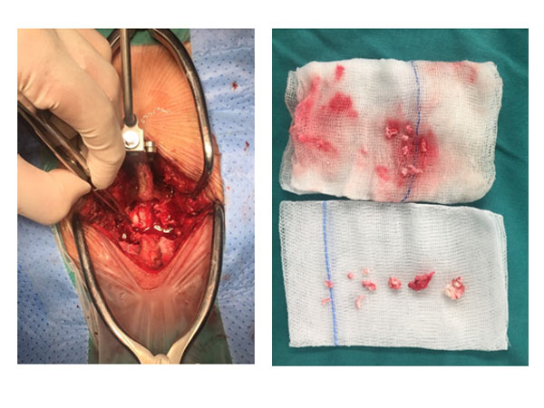 Hình 3: Hình ảnh trong mổ