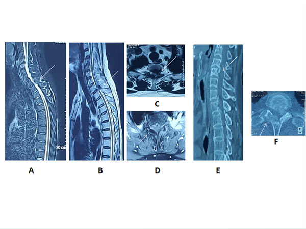 Hình 2: Phim chụp cắt lớp vi tính và cộng hưởng từ cột sống ngực