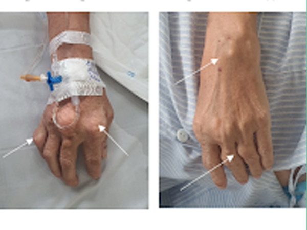 Hình 1: Hình ảnh hạt tophi tại các khớp bàn, ngón tay bệnh nhân.