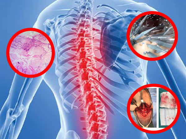 CHÈN ÉP TỦY NGỰC DO HẠT TOPHI TRONG ỐNG SỐNG