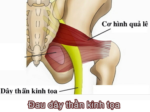 ĐAU DÂY THẦN KINH TỌA