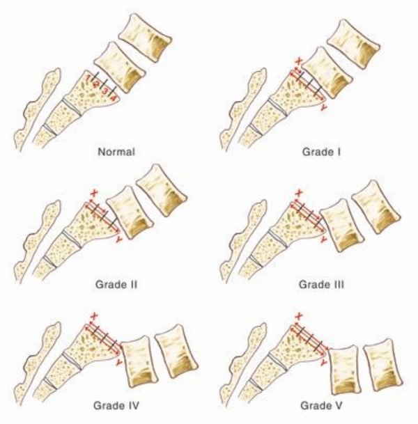 Hình 1: Phân loại trượt đốt sống theo Meyerding