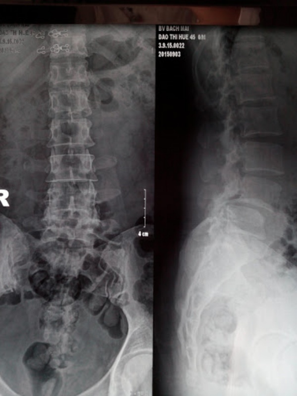 Hình 2: Trượt L45 trên X-quang