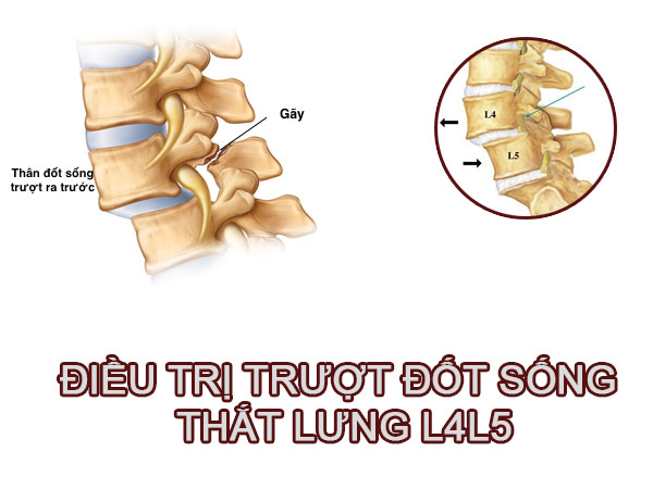 ĐIỀU TRỊ TRƯỢT ĐỐT SỐNG THẮT LƯNG L4L5 BẰNG PHẪU THUẬT LẤY ĐĨA ĐỆM, CỐ ĐỊNH CỘT SỐNG VÀ GHÉP XƯƠNG LIÊN THÂN ĐỐT