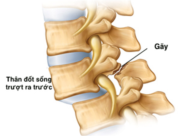Đốt sống thắt lưng L4 L5 bị trượt