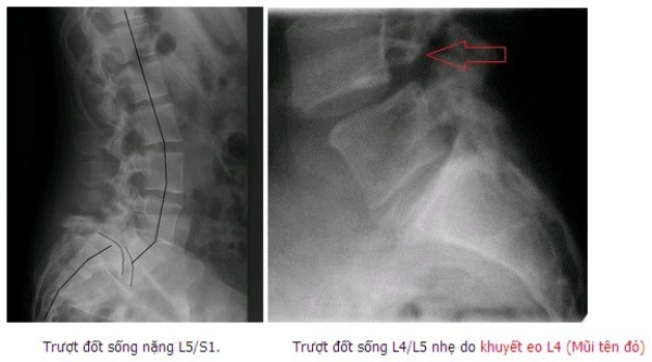 Hình ảnh trượt đốt sống thắt lưng