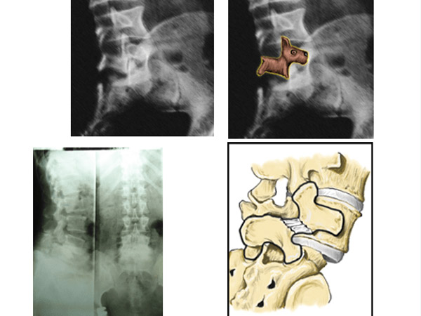 Tổng hợp hình ảnh trượt đốt sống thắt lưng