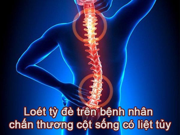 THỰC TRẠNG LOÉT TỲ ĐÈ TRÊN BỆNH NHÂN CHẤN THƯƠNG CỘT SỐNG CÓ LIỆT TỦY TẠI KHOA CHẤN THƯƠNG CHỈNH HÌNH VÀ CỘT SỐNG BỆNH VIỆN BẠCH MAI