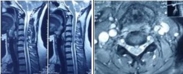 Hình 1. Thoát vị đĩa đệm trêm MRI
