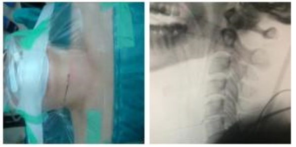 Hình 2. Đường rạch da, Xquang trong mổ