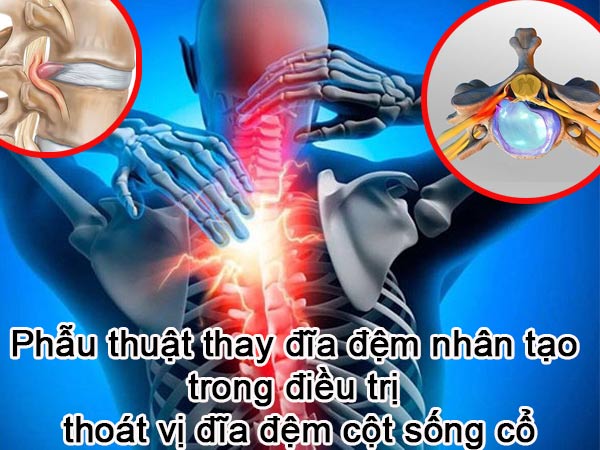 PHẪU THUẬT THAY ĐĨA ĐỆM NHÂN TẠO TRONG ĐIỀU TRỊ THOÁT VỊ ĐĨA ĐỆM CỘT SỐNG CỔ