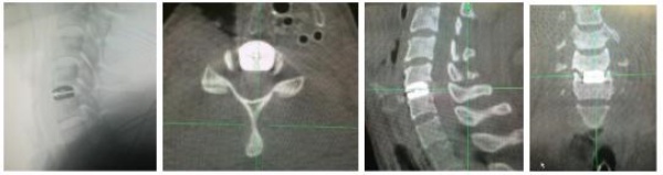Hình 4. Chụp Xquang, O-arm kiểm tra đĩa đệm trong mổ