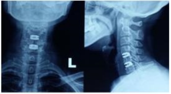 Hình 5. Xquang đĩa đệm nhân tạo C4C5 – C5C6 sau mổ