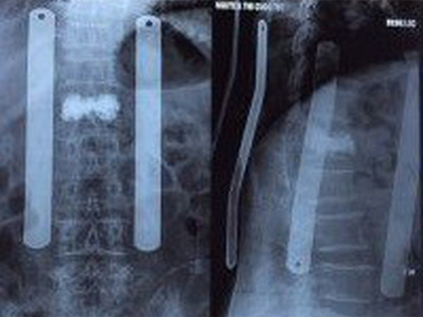 Tạo hình thân đốt sống có lún xẹp đốt sống