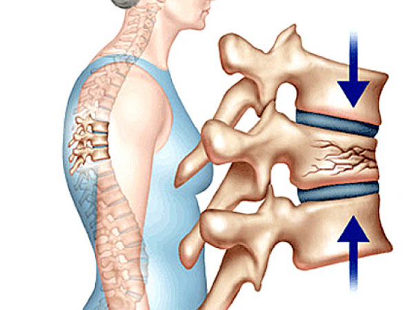Hình ảnh thân đốt sống bị xẹp