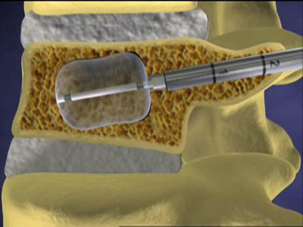 Tạo hình thân đốt sống có bóng