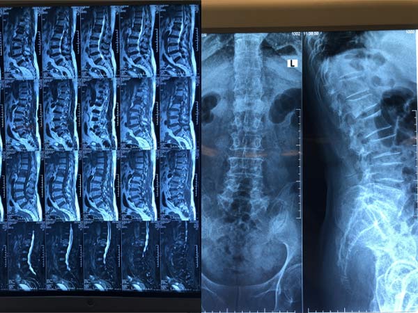 Chẩn đoán tạo hình thân đốt sống