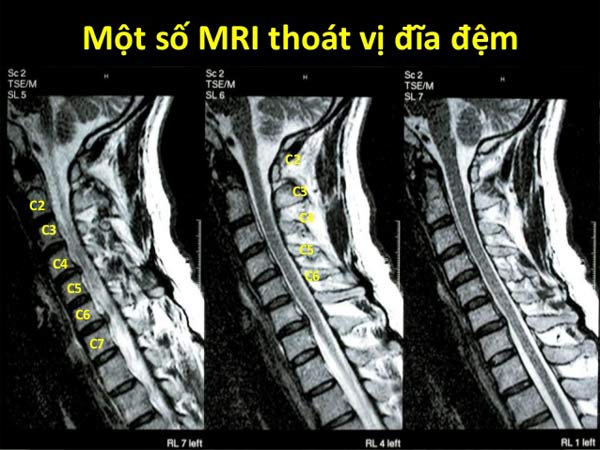 Một số hình thái thoát vị đĩa đệm cột sống cổ trên MRI