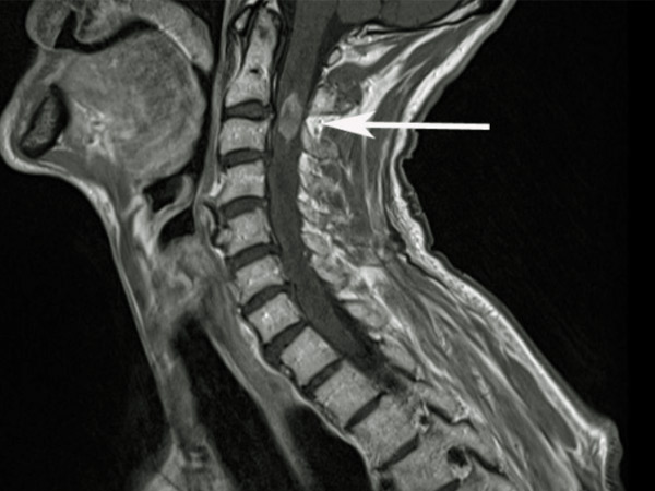 Kết quả chụp cộng hưởng từ cột sống cổ