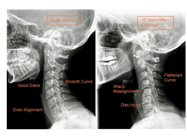 Hình ảnh mất đường cong sinh lý