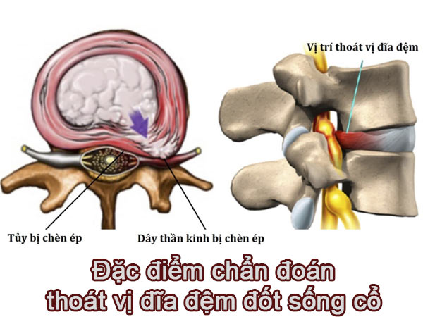 ĐẶC ĐIỂM CHẨN ĐOÁN HÌNH ẢNH THOÁT VỊ ĐĨA ĐỆM CỘT SỐNG CỔ Ở BỆNH NHÂN ĐƯỢC PHẪU THUẬT LẤY ĐĨA ĐỆM, HÀN XƯƠNG LIÊN THÂN ĐỐT VÀ NẸP VÍT CỘT SỐNG CỔ LỐI TRƯỚC