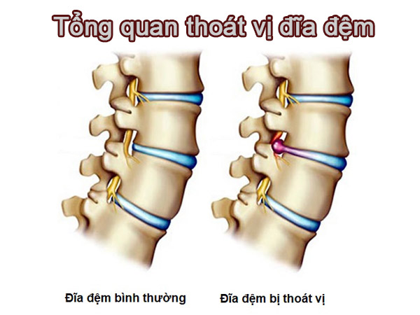 TỔNG QUAN VỀ THOÁT VỊ ĐĨA ĐỆM CỘT SỐNG